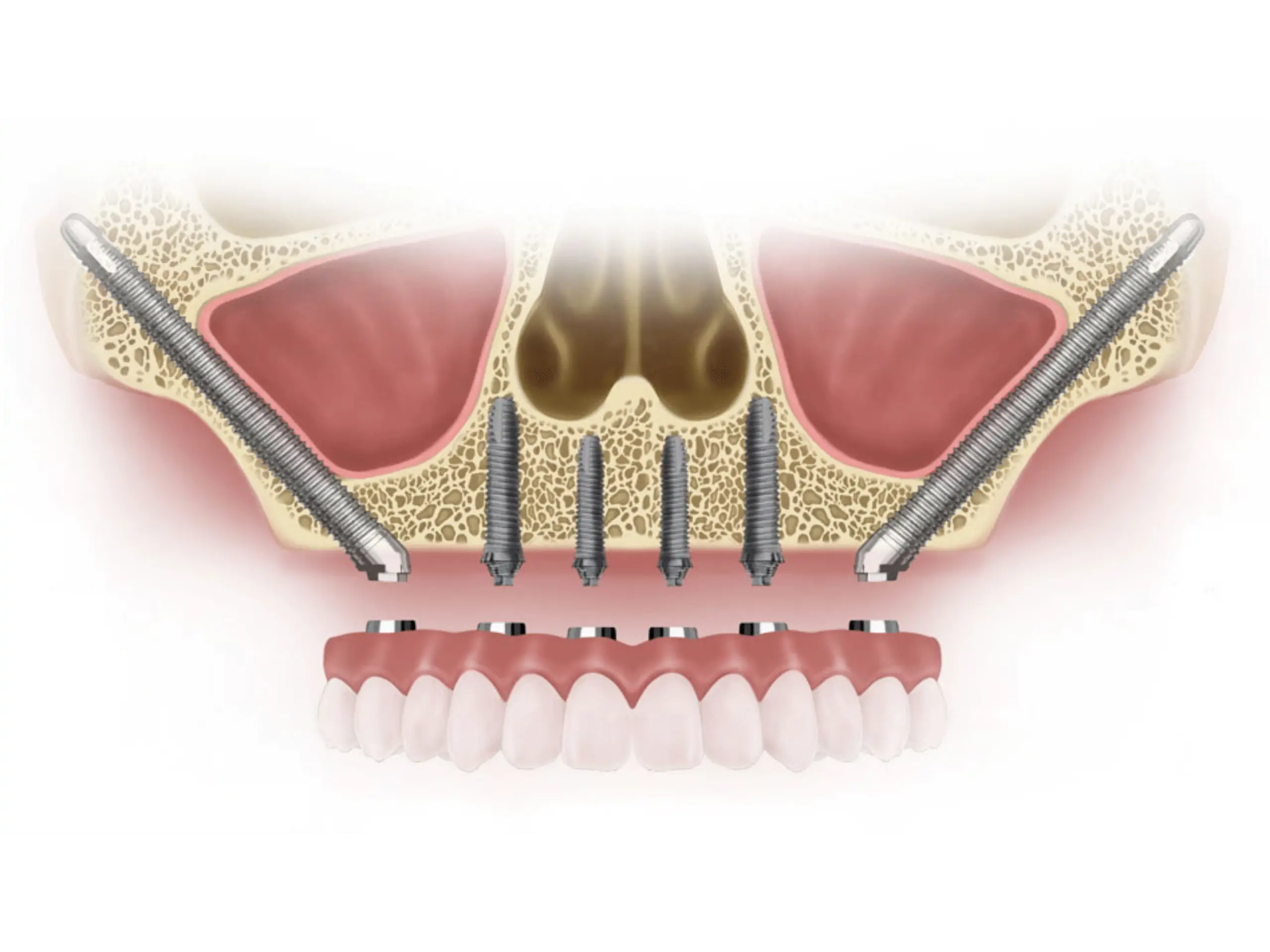 inexpensive dental implants near me